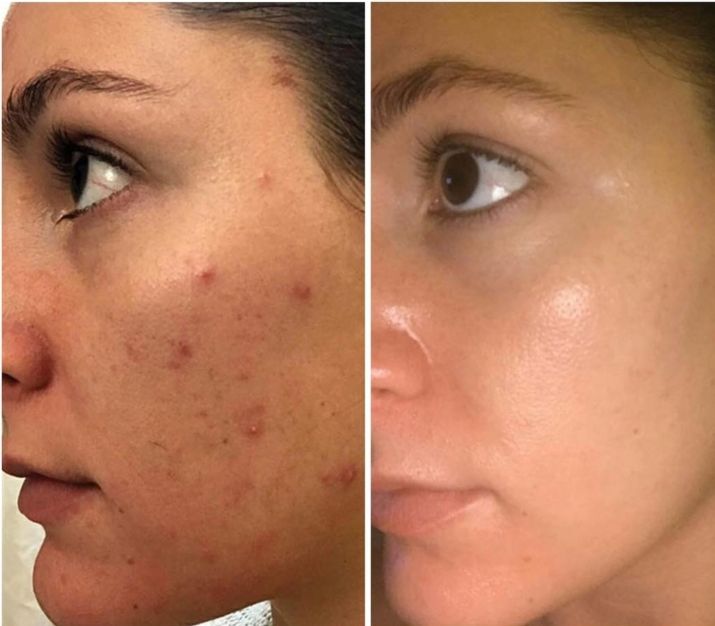 Before and after facial for acne and texture on the cheek