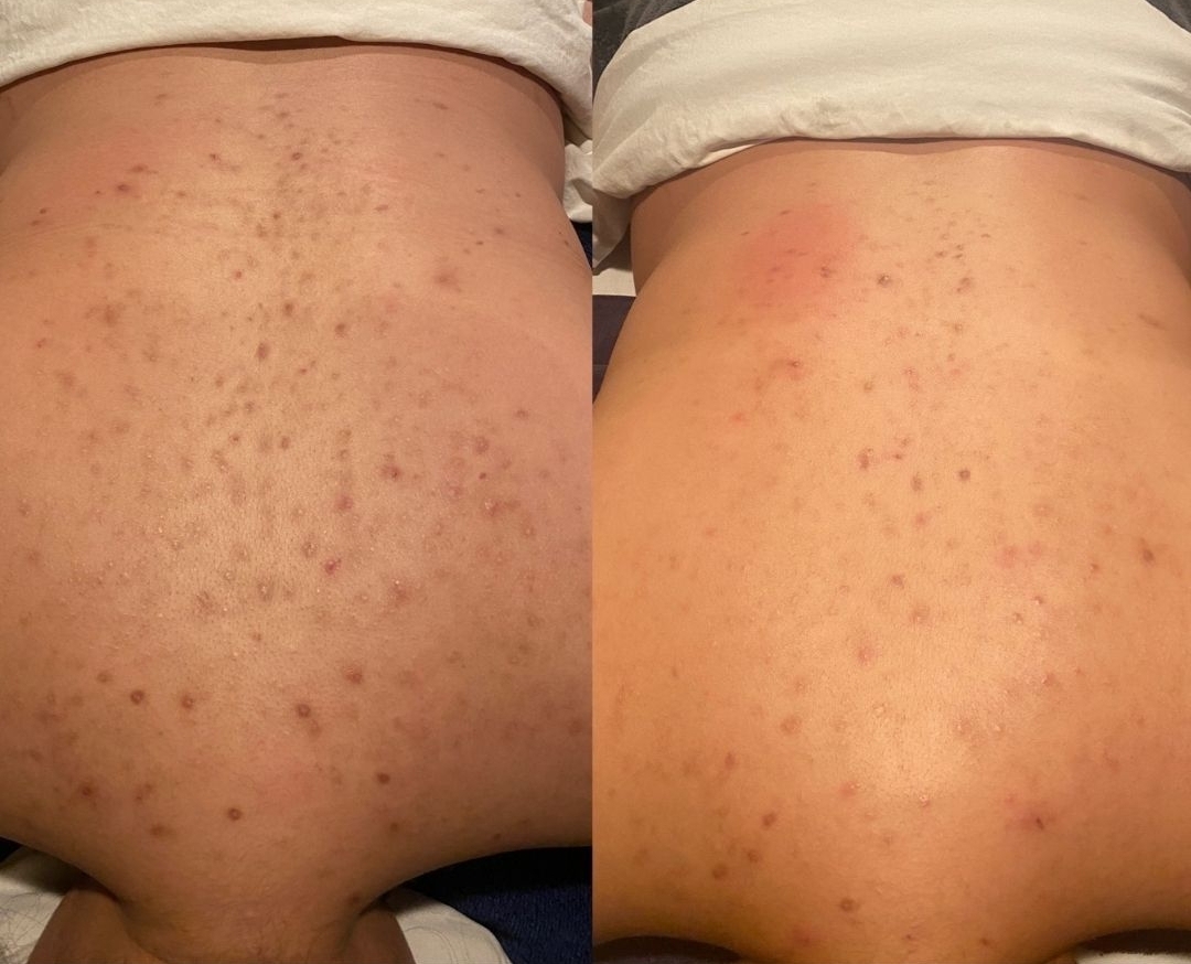 Before and after back acne treatment