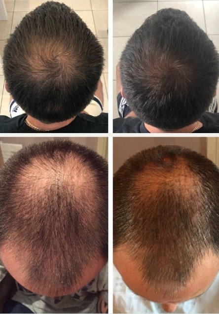 Four stage progress of crown hair regrowth