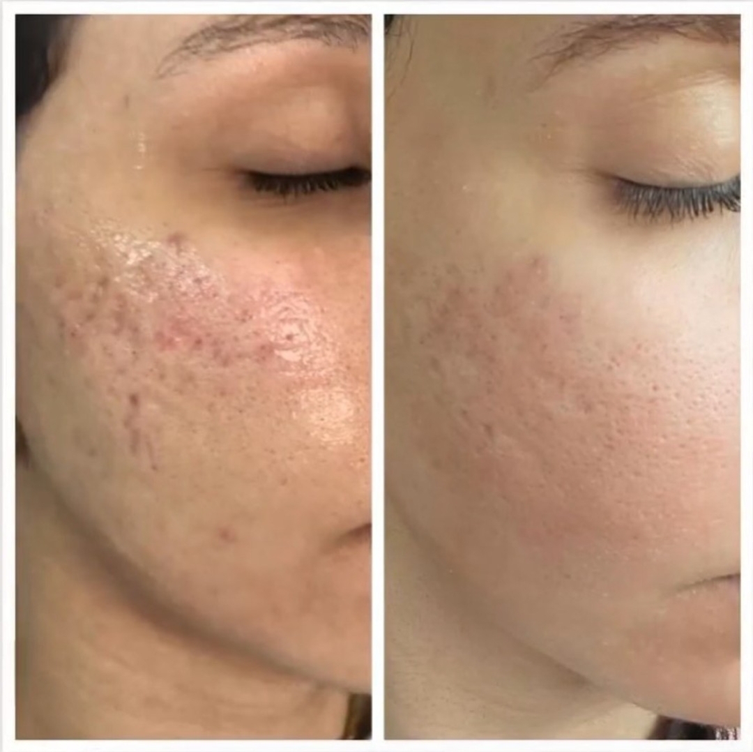 Before and after microneedling for acne scarring