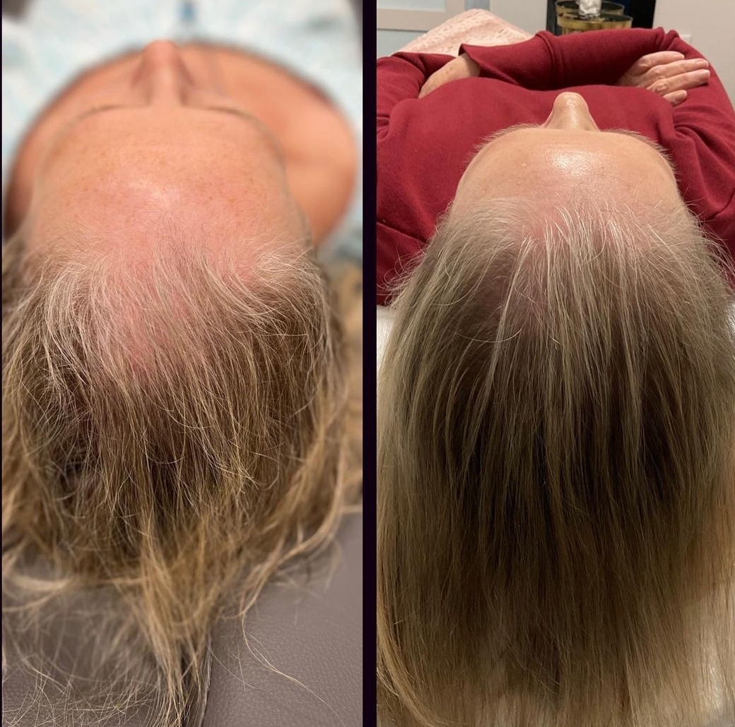 Before and after crown hair regrowth