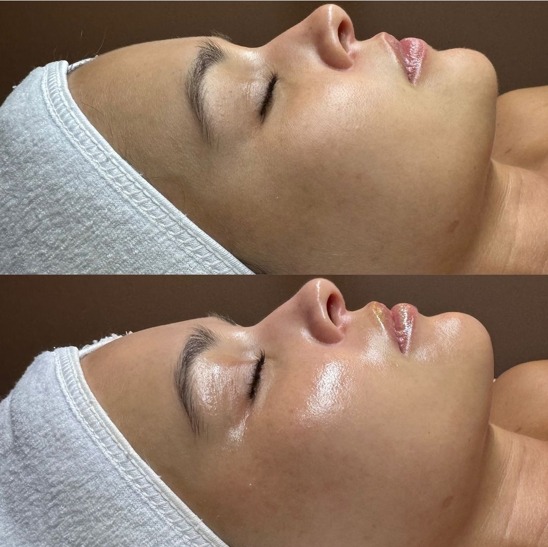Before and after glow facial