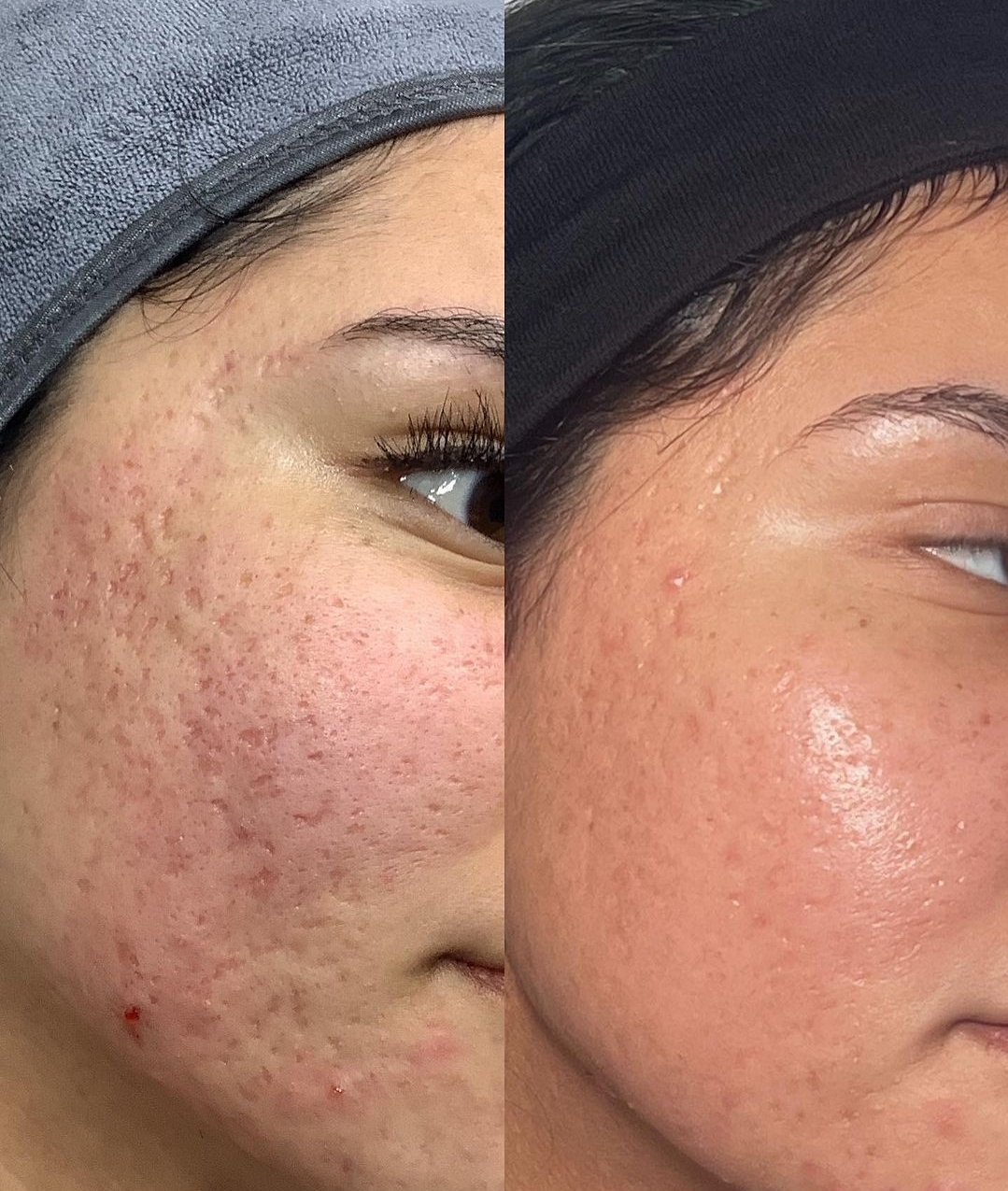 Before and after facial for acne and skin texture