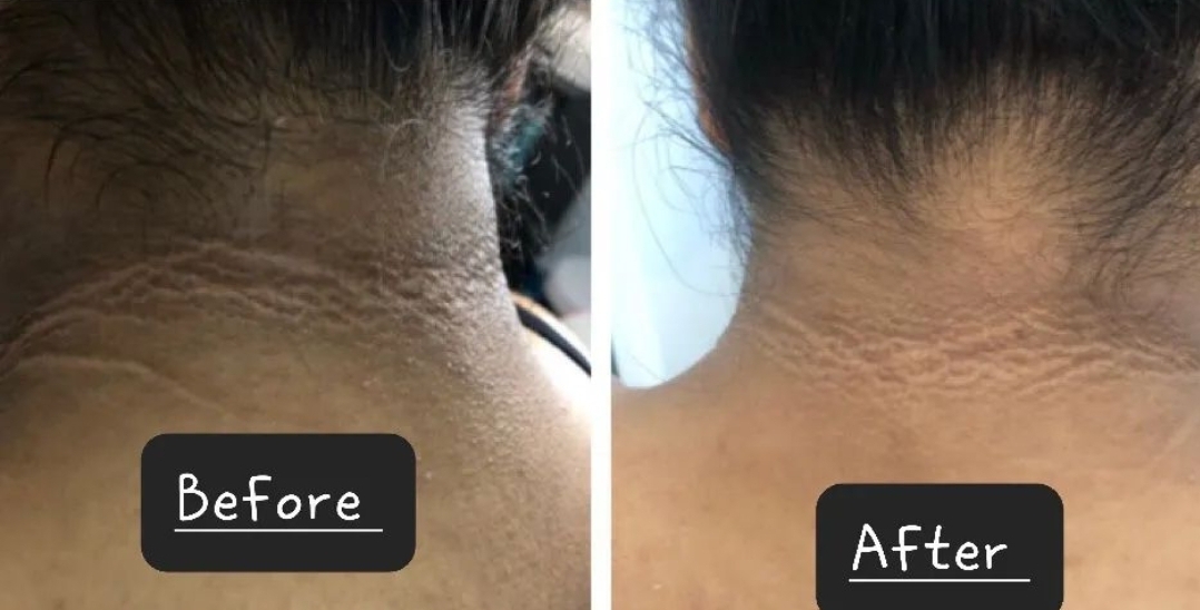 Before and after treatment for neck lines and texture