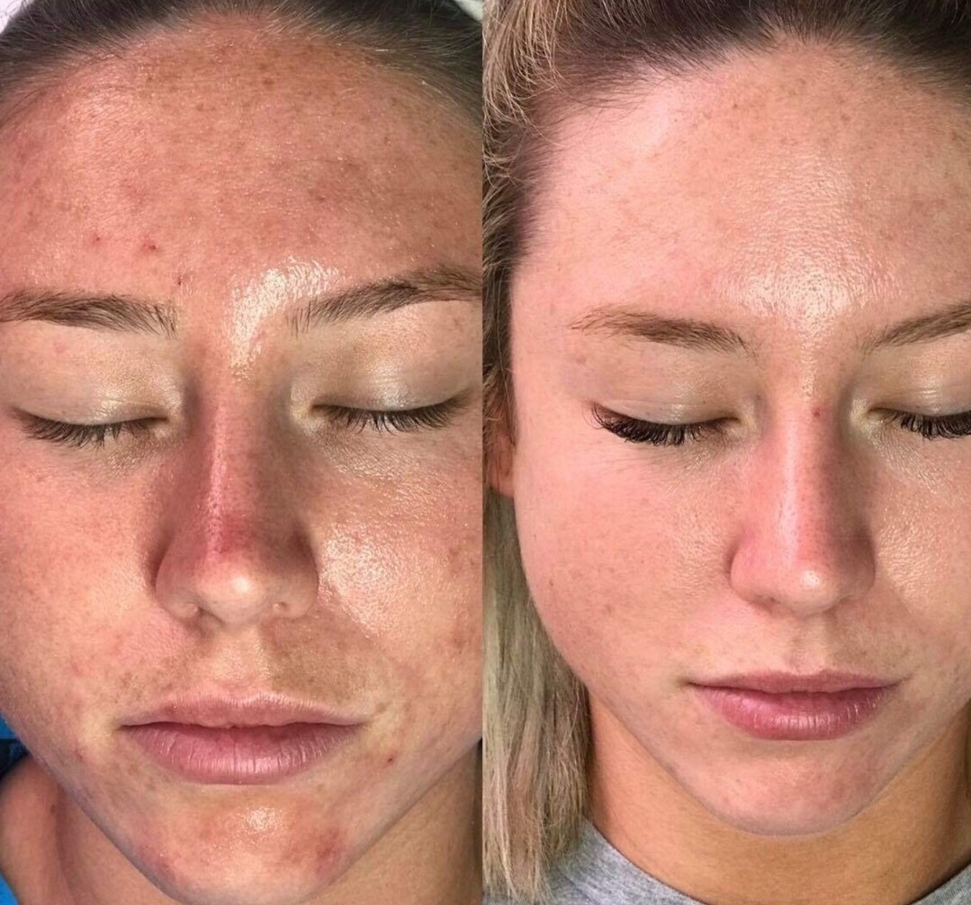 Before and after full face pigmentation and texture treatment