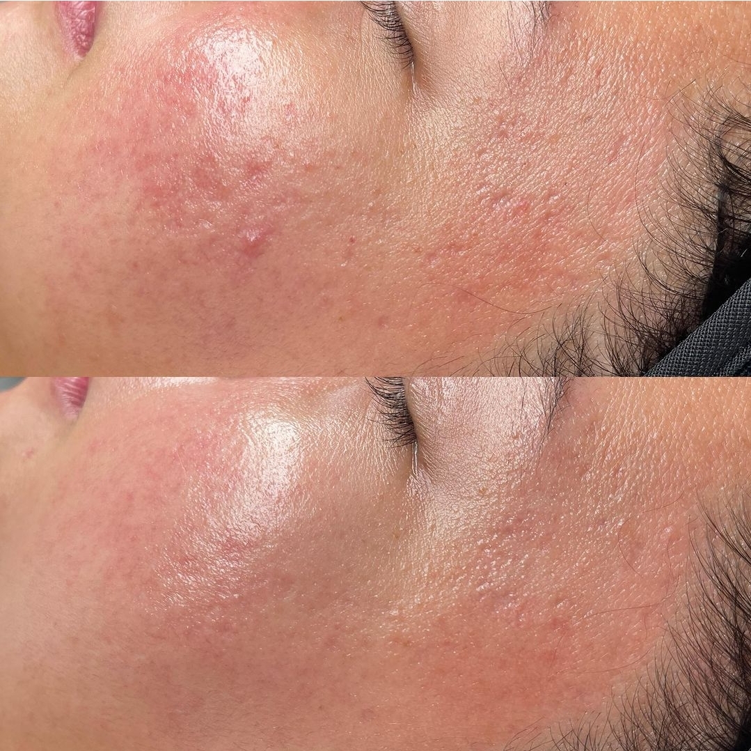 Before and after treatment for facial redness and texture