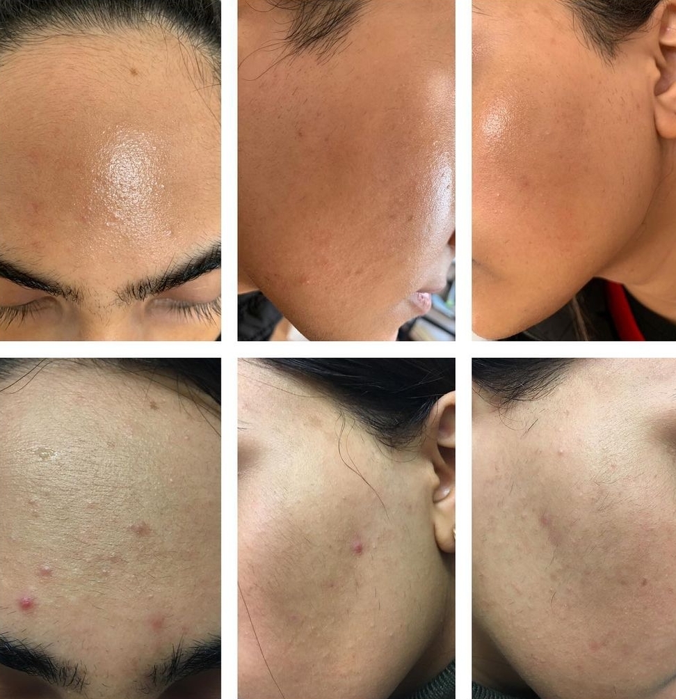 Skin clarity progress over six stages of treatment