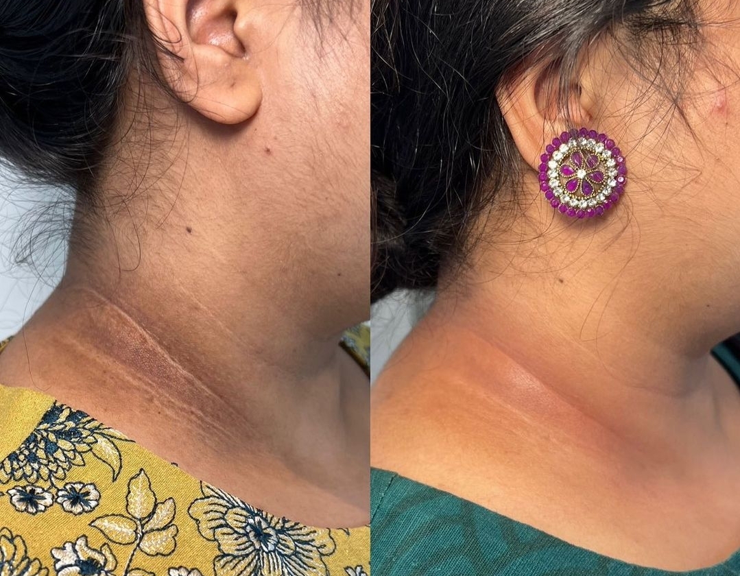Before and after neck pigmentation and texture treatment