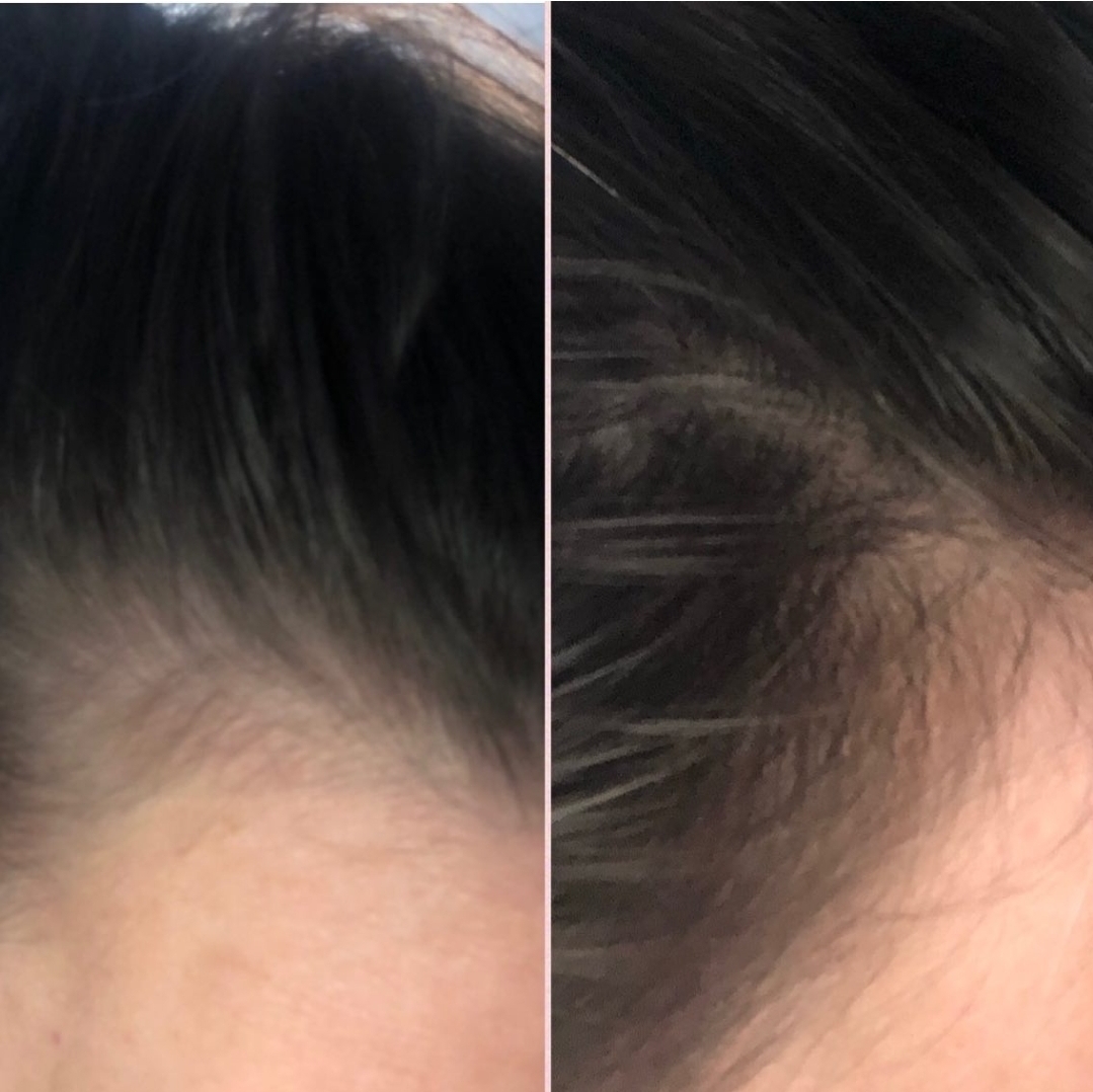 Before and after hairline regrowth with microneedling