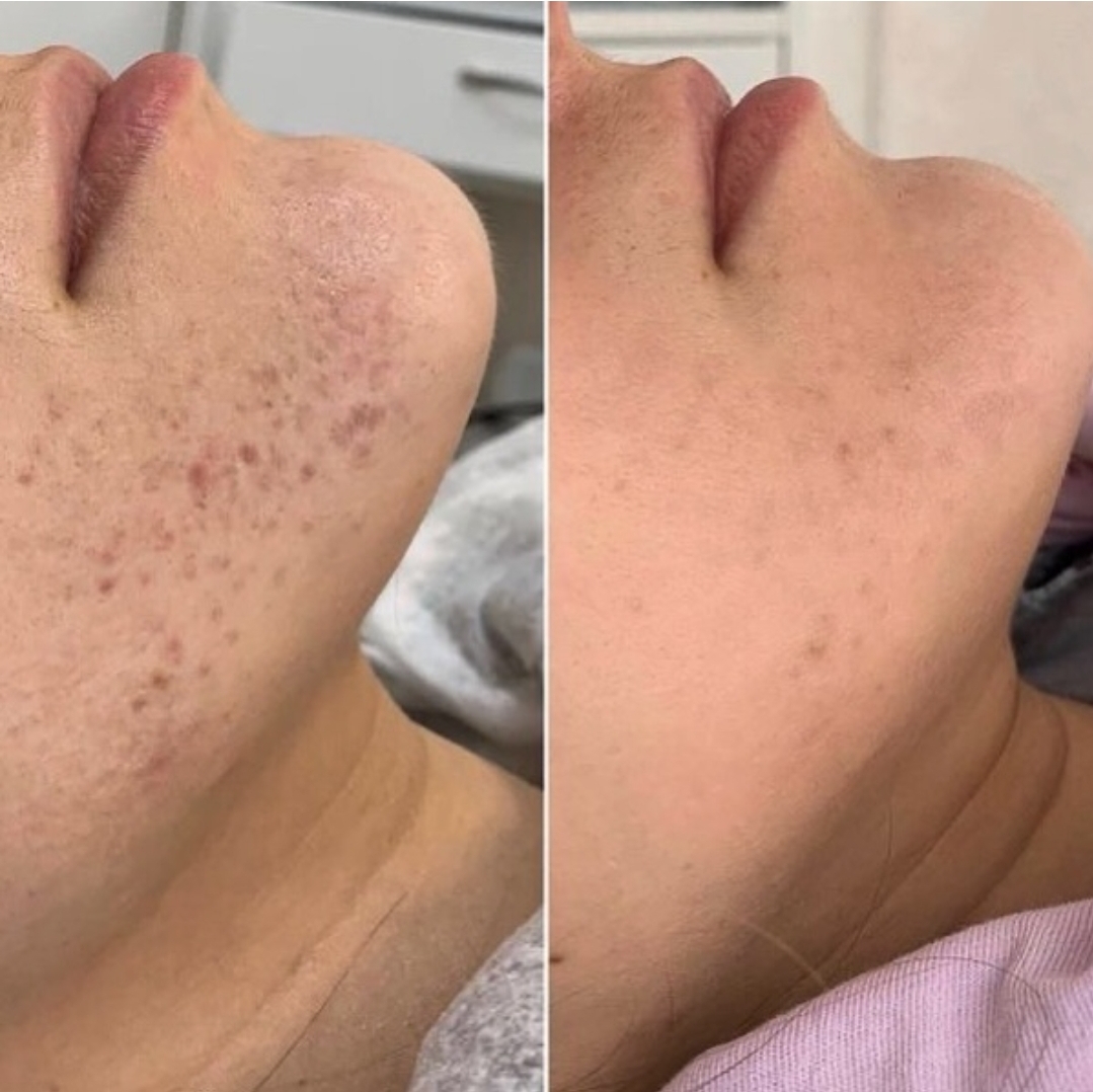 Before and after treatment for jawline acne and pigmentation