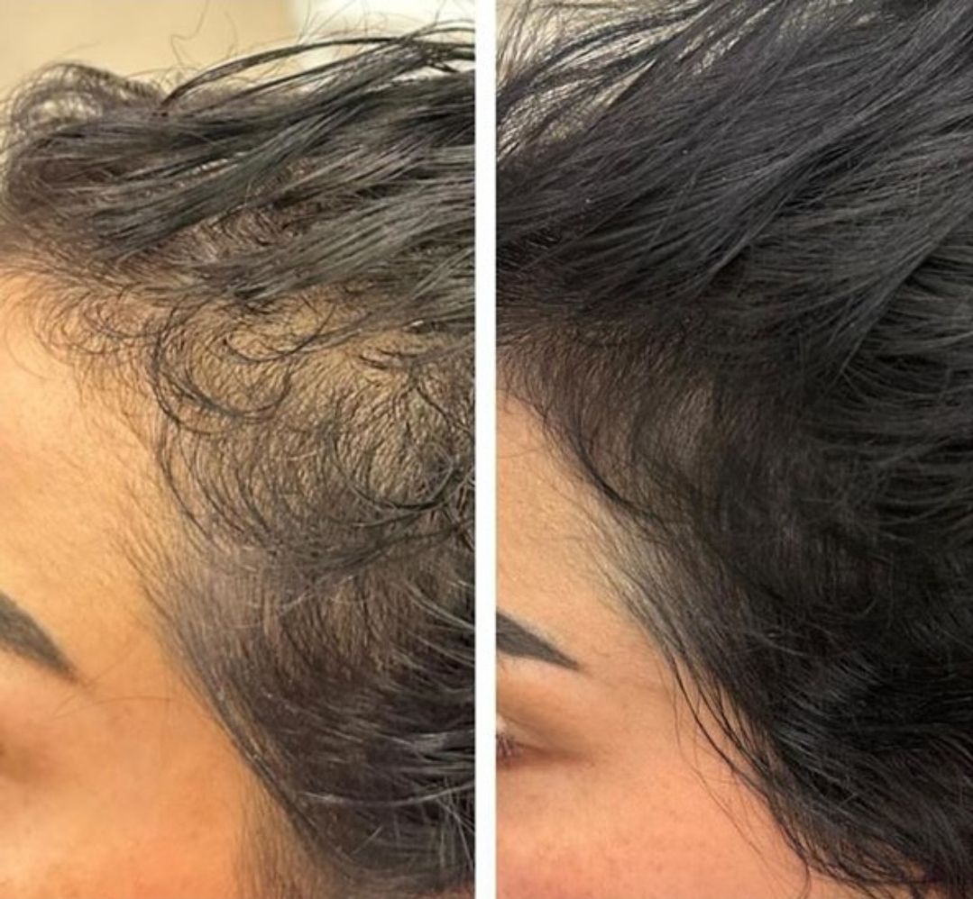 Before and after hairline and crown regrowth