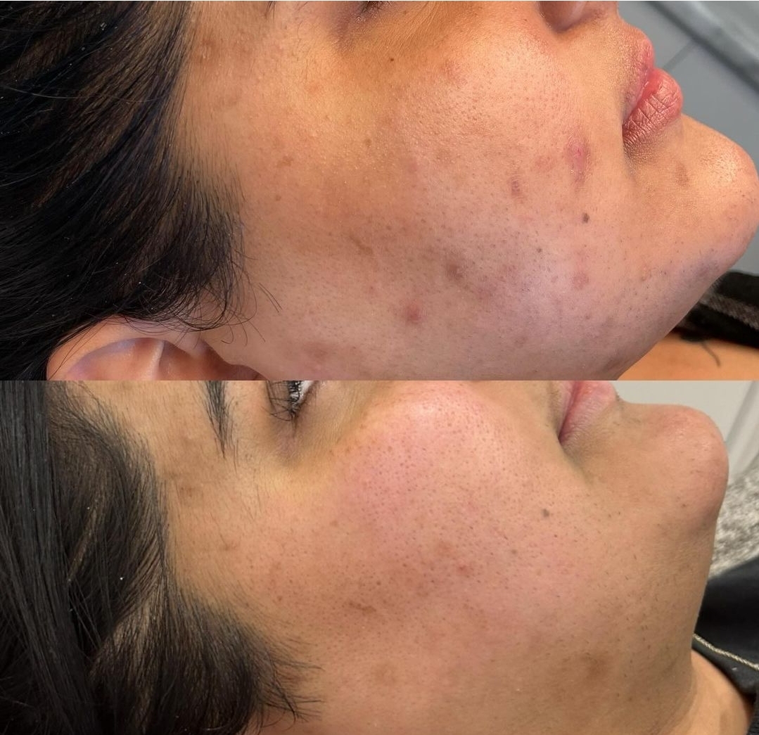 Before and after treatment for pigmentation and blemishes